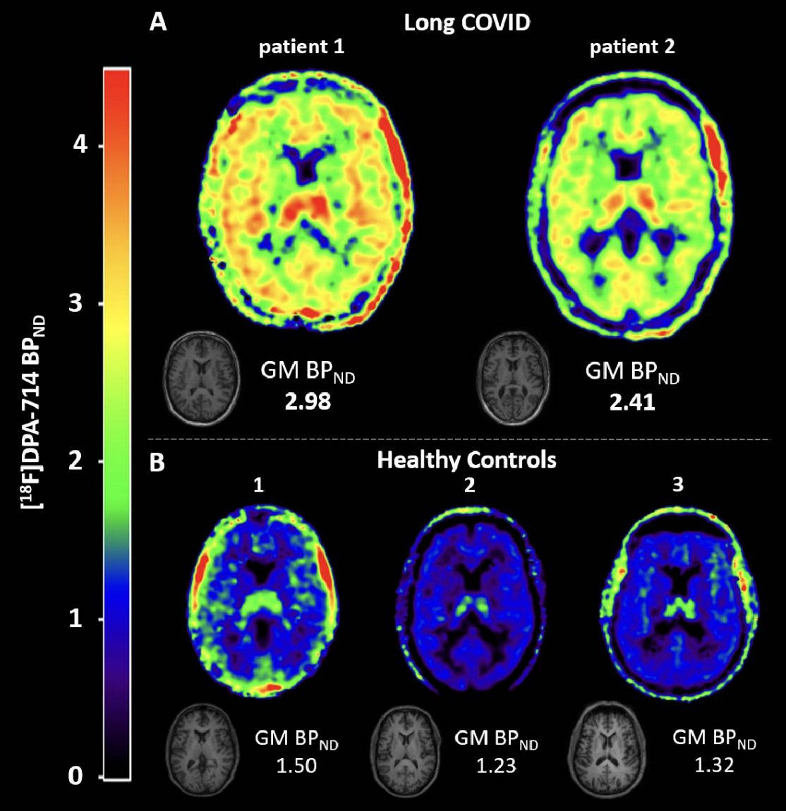 Fatigue and brain fog due to long COVID: What’s going wrong in the ...