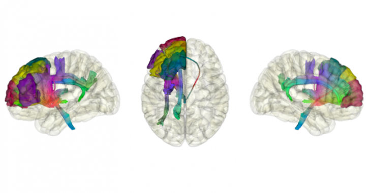 De mysteries achter hersenherstel ontrafeld: hoe onderzoek revalidatie bevordert